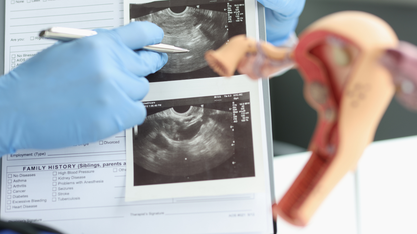 Clinical efficacy of Viddha Karma in the management of polycystic ovary syndrome